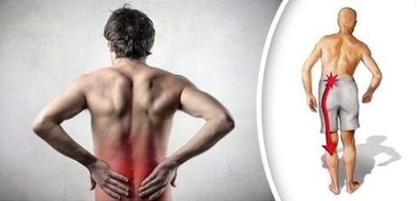 Skausmo sindromas su juosmens osteochondroze spinduliuoja kojoms